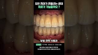 맑은플란트에서 진행한#전체임플란트 치료 케이스