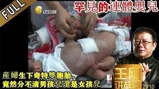 王剛講故事 ：不要死別要生離：産婦生下奇特雙胞胎，竟然分不清男孩兒還是女孩兒。罕見的連體嬰兒，可愛、可憐、又可歎。如何確定嬰兒性別？又該怎洋拯救孩子的生命？