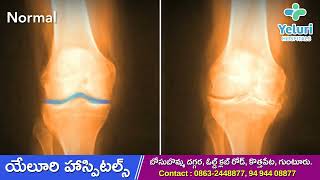 ఆస్టియో ఆర్థరైటిస్ అంటే ఏమిటి ? | Osteoarthritis symptoms | DR. Y. RAMAKRISHNA | YELURI HOSPITALS