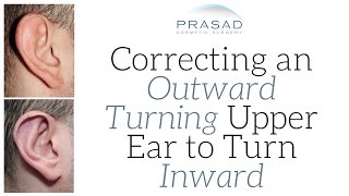 Cause of an Outward Turning Upper Ear, and the Surgical Correction to Turn it Inward