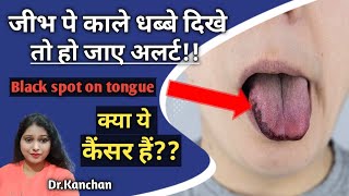 Black spot on tongue/जीभ पे काले धब्बे के कारण और इलाज/Dr. Kanchan Singh