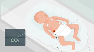 Transcutaneous Monitoring in the NICU