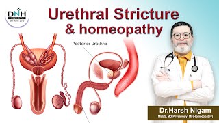 Urethral stricture & homeopathy || Urethral Stricture