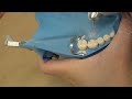 pin retained amalgam