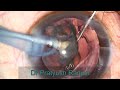 cortical plate aspiration in grade 1 cataract