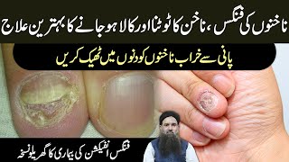 Fungus Ka ilaj | Fungal infection Ka ilaj | Nakhun Tootne Ka ilaj Dr Sharafat Ali Health Tips Urdu
