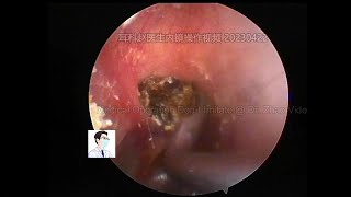 A cholesteatoma Looks like a blackhead in ear,20230422