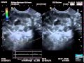 Advanced EUS Imaging for Pancreatic Diseases: CE-EUS (Low-MI, High-MI), Real-Time Elastography, 3D