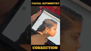 Facial Asymmetry Correction in India - Dr Mathew PC #shorts