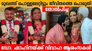 മുഖത്ത് പൊള്ളലേറ്റിട്ടും ജീവിതത്തെ പൊരുതി തോൽപിച്ച Dr. SHAHINA യ്ക്ക് വിവാഹ ആശംസകൾ 😍 Shahina Wedding