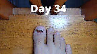 Toenail Timelapse