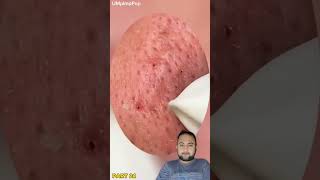 Derm Reacts to Blackheads Removal || Acne Treatment \u0026 very Satisfying Pimple Pop | Part 24