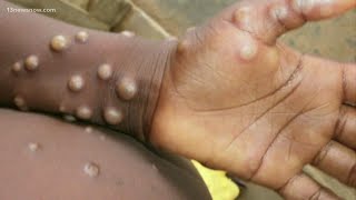 What you need to know about the monkeypox outbreak