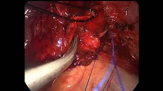 UNIPORTAL VATS LEFT LOWER SLEEVE LOBECTOMY