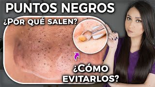 BLACKHEADS l What causes them and how to avoid them? l Dr. Pau Zúñiga