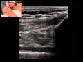 Musculoskeletal Ultrasound: Knee 1: suprapatellar longitudinal scan