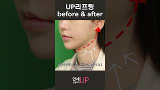 작고 매끄러운 얼굴라인! 작고 갸름하게 UP Lifting! #업리프팅 #미니거상 #안면거상