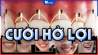 Cười hở lợi phải làm sao? Tướng số người cười hở lợi