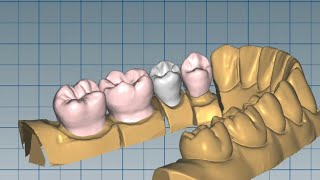 ceramill mind cadcam design: | posterior anatomic bridge | for cadcam.