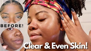 These Products Cleared My Skin! | Skincare for Hyperpigmented, Acne Prone, Oily Skin