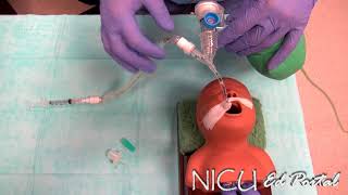 Surfactant administration in a preterm infant