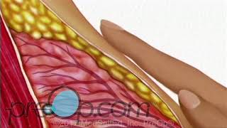 Breast Needle Biopsy Procedure • Patient Education Surgery