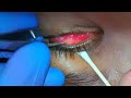 botulinum toxin botox injection to the lacrimal gland