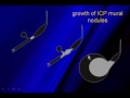 Non Simple Cysts and Color Doppler in Breast Sonography