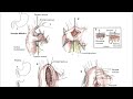 pyloroplasty