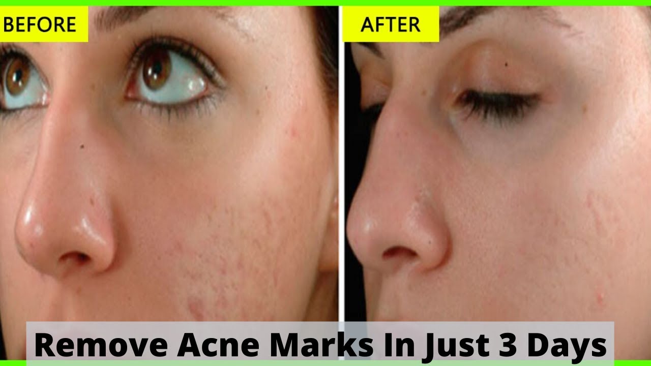 How To Get Rid Of Acne Scars Naturally In Just 3 Days 5 Home Remedies