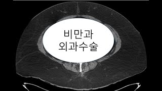 [#외과의사] #비만 한 환자를 #수술해야 할때...