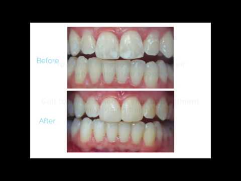 White spots after braces? White spots after braces?