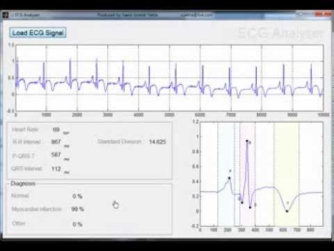 Automatic Ecg Signal Analysis Youtube