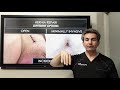 What you need to know about inguinal hernia repair by Dr. Iraniha