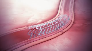 The Benefits of Bioresorbable Stents