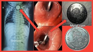 Pediatric Foreign Body Removal Of Metal Coin শিশুর খাদ্যনালী থেকে টাকার কয়েন বের হল #BD_ENDOSCOPY