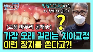 1-111. 가장 오래 걸리는 치아교정은 뭘까요??