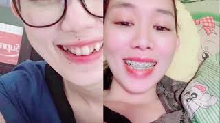 ពត់ធ្មេញ Bend the teeth