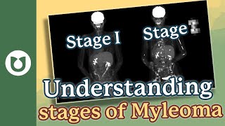 How do I Know the Stage of my Myeloma?
