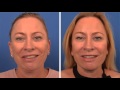 Goals of Facial Reanimation Surgery | Facial Paralysis