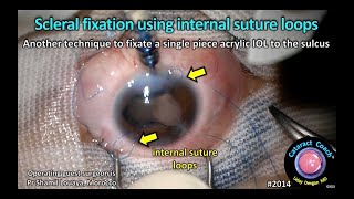 CataractCoach™ 2014: scleral fixation using internal suture loops