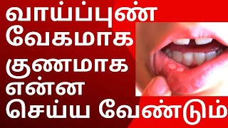 வாய் புண் வேகமாக குணமாக | vaai pun treatment in tamil | Mouth Ulcer Treatment