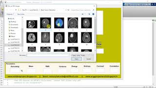 Brain Tumor Detection Using Machine Learning Algorithm Matlab Project Source Code
