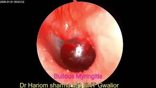 Bullous Myringitis / Inflamed Tympanic Membrane / Inflamed Ear Drum / Acute Otitis Media