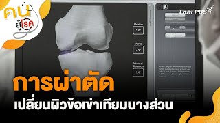 การผ่าตัดเปลี่ยนผิวข้อเข่าเทียมบางส่วน | คนสู้โรค