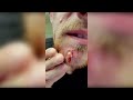 Popping huge blackheads and Pimple Popping - Best Pimple Popping Videos - 1