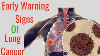 Early Warning Signs of Lung Cancer