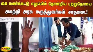 கை மணிக்‍கட்டு எலும்பில் ​தோன்றிய அறிய வகை புற்றுநோய் | Salem Govt Hospital | Wrist Bone Cancer