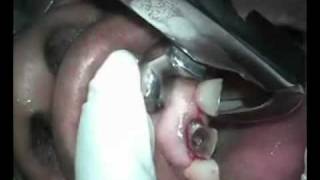 Extraction of teeth #7-10 with Physics Forceps