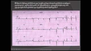 ეკგ / წინაგულების ფიბრილაცია და გულის ინფარქტი /  დისპნოე და გულის არეში ტკივილი